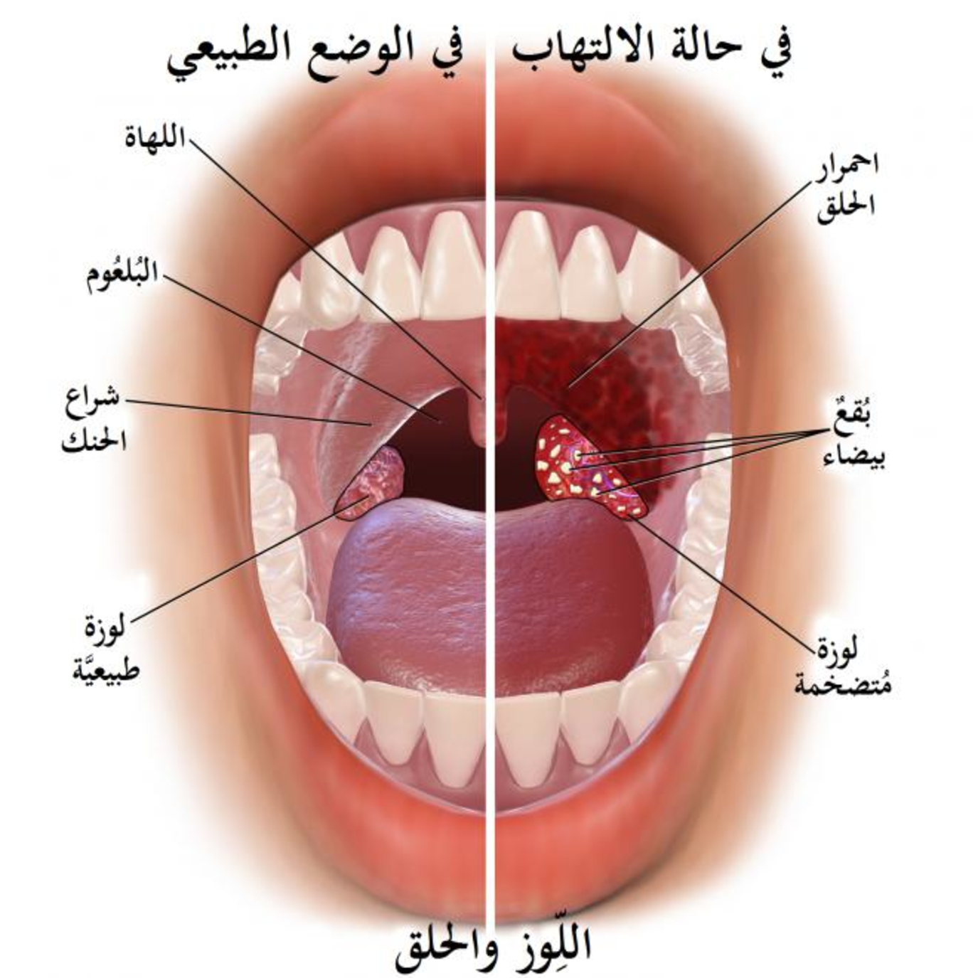 التهاب الحلق لمدة طويلة قد يكون سبب للوفاة